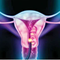 জরায়ু ক্যান্সার