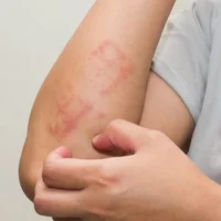 অ্যালার্জি