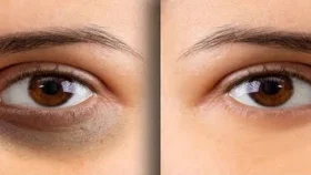 যে ৩ সবজিতেই দূর হবে চোখের নিচে কালো দাগ 