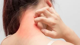 যেসব খাবার খেলে বাড়ে অ্যালার্জি