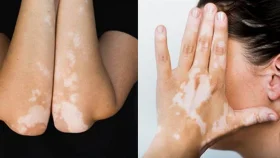 শ্বেতীরোগের স্থায়ী নিরাময় নেই, তবে নিয়ন্ত্রণ সম্ভব