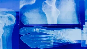 ৩ মিনিটে হাড় জোড়া লাগাবে যে আঠা