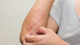 অ্যালার্জি থেকে বাঁচতে খাদ্যতালিকায় রাখুন ৫ খাবার