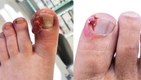 নখকুনি প্রতিরোধের ঘরোয়া উপায়