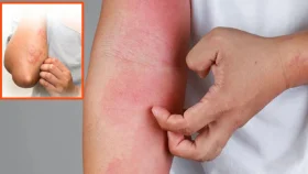 করোনার টিকা নয়, পরিবেশ দূষণের কারণে বাড়ছে অ্যালার্জি