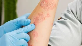 শীতে এলার্জির সমস্যা রোধে ৫ উপায়