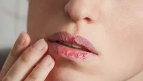 এই শীতে ঠোঁট ও মুখের ঘা এড়াতে করণীয়