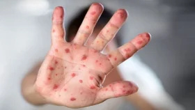 ফ্লোরিডায় হামের প্রাদুর্ভাব, তথ্য গোপনের অভিযোগ