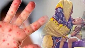 হাম ও উপসর্গে আরও ৭ শিশুর মৃত্যু