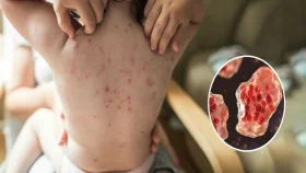 হাম হলে বুঝবেন কীভাবে, লক্ষণ ও করণীয় জেনে নিন এখনই