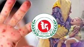 ২৪ ঘণ্টায় হাম ও উপসর্গ নিয়ে আরও ৮ শিশুর মৃত্যু