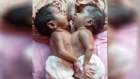 জোড়া লাগানো দুই শিশুর চিকিৎসা অনিশ্চিত, আর্থিক সংকটে পরিবার