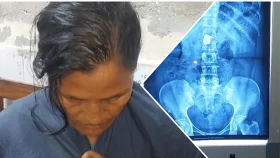 চুরি করা চেইন পেটে, এক্স-রে-তে ধরা