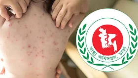 হাম উপসর্গে আরও ৫ শিশুর মৃত্যু