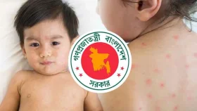 হাম উপসর্গে দেশে আরও ৭ শিশুর মৃত্যু
