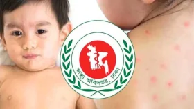 হাম উপসর্গে আরও ৫ জনের মৃত্যু