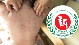 হামের উপসর্গে আরও ৫ জনের মৃত্যু