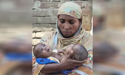 মায়ের কোলে জোড়া লাগানো শিশু জয়নব ও উম্মে কুলসুম